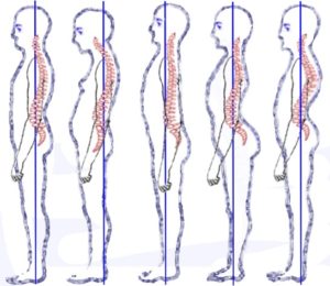 Mal di schiena e postura